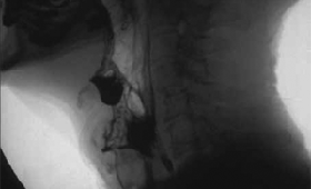 geriatricarea deglución