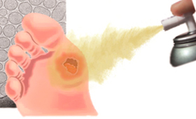 geriatricarea úlceras de pie diabético