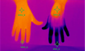 Geriatricarea Parkinson Biocruces