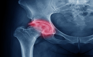 Geriatricarea fractura de cadera Ballesol