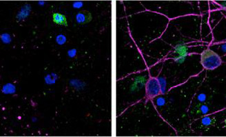 geriatricarea ictus alzheimer proteína PKD