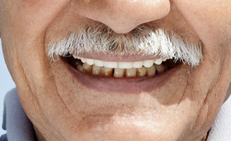 geriatricarea enfermedad periodontal artritis reumatoide