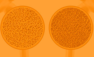 geriatricarea osteoporosis UCB