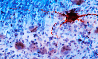 geriatricarea alzheimer