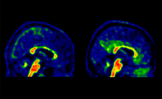 geriatricarea Alzheimer beta amiloide
