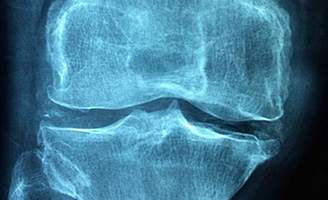 geriatricarea ospeoporosis