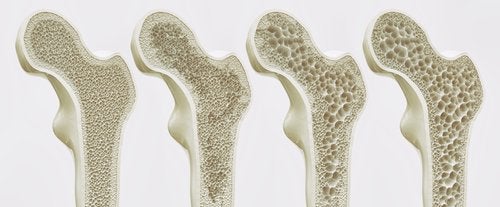 geriatricarea osteoporosis