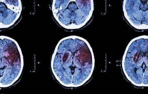 geriatricarea enfermedades neurologicas
