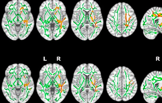 geriatricarea insomnio alzheimer