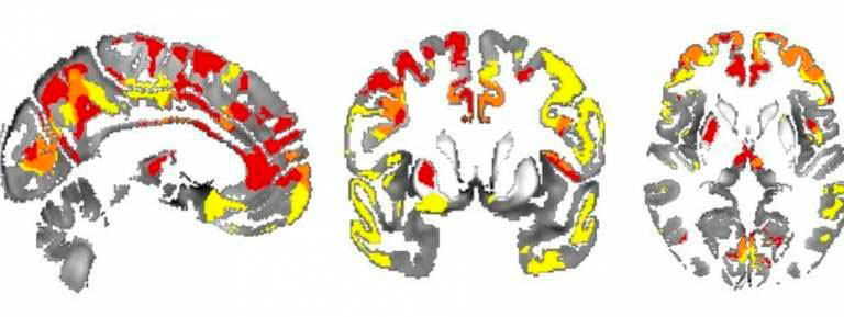 geriatricarea parkinson