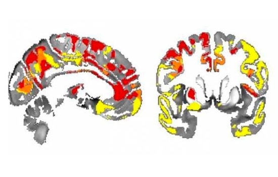 geriatricarea parkinson hierro