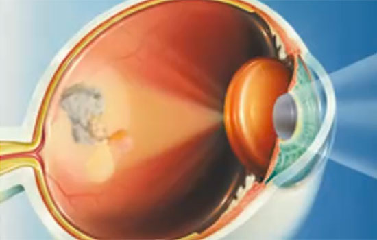 geriatricarea cataratas.jpg