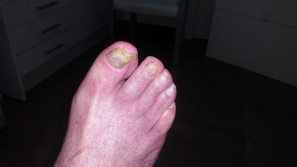 geriatricarea pie diabetico