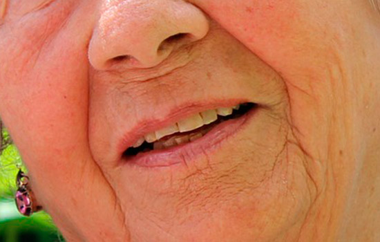 geriatricarea periodontitis