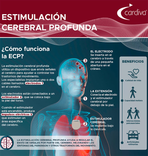 geriatricarea estimulacion cerebral profunda cardiva