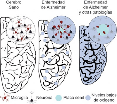 geriatricarea Enfermedad de Alzheimer