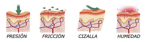 geriatricarea ulcera por presion