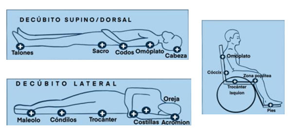 geriatricarea ulceras por presion