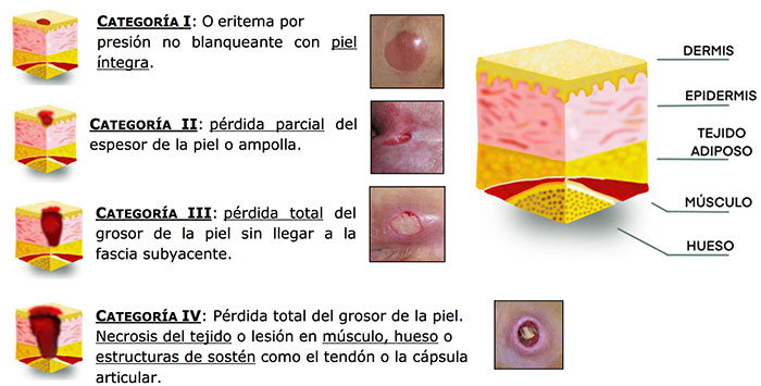 geriatricarea-ulceras-por-presion