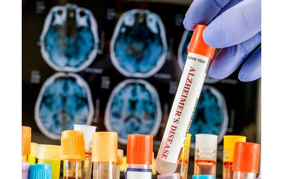 Geriatricarea, diagnóstico precoz del Alzheimer