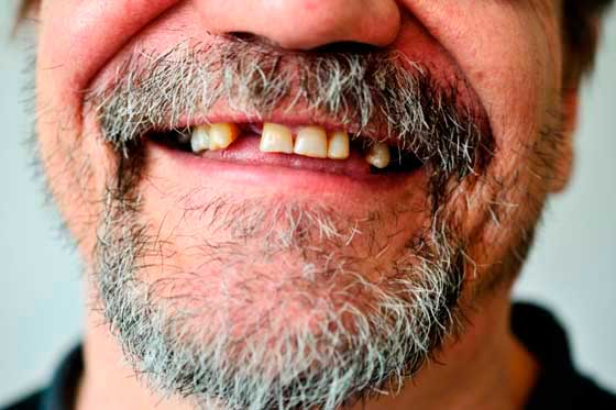 Geriatricarea, Edentulismo o pérdida de dientes, Sanitas