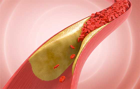 geriatricarea aterosclerosis colesteror cardioalianza