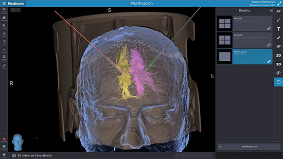 geriatricarea estimulacion cerebral profunda dolor cronico