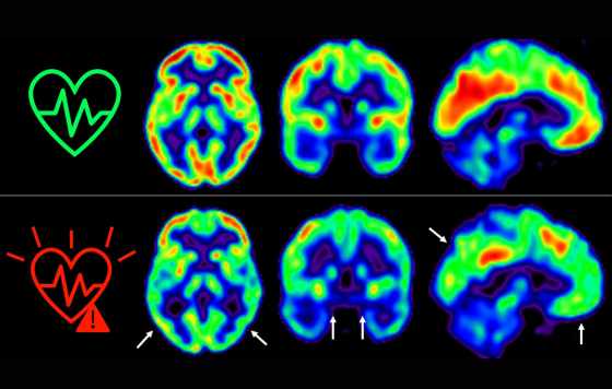 Geriatricarea- La aterosclerosis aumenta el riesgo de sufrir