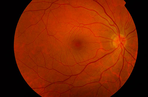 geriatricarea alzheimer retina