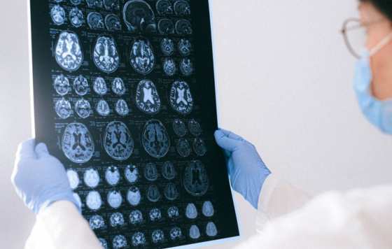 Geriatricarea- Nuevos indicadores para el diagnóstico temprano del Alzheimer