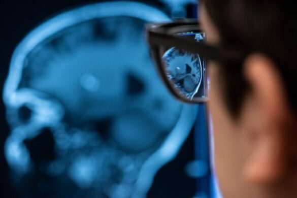 geriatricarea demencia cerebro