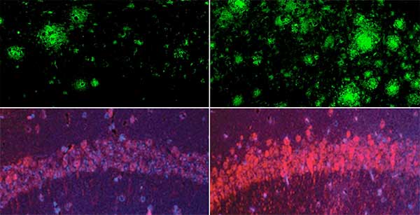 geriatricarea litio alzheimer