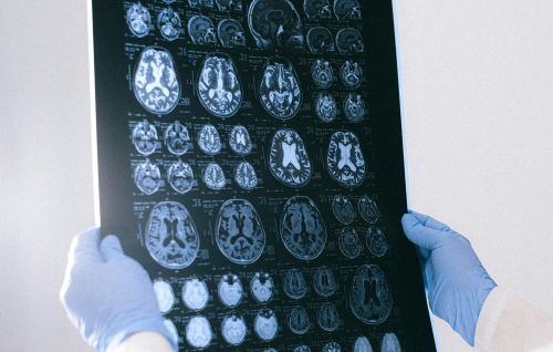 geriatricarea riesgo genetico alzheimer