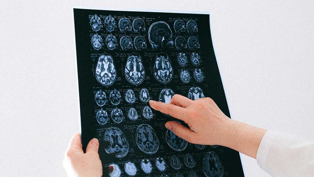 geriatricarea APOE alzheimer