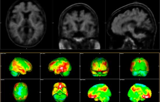 geriatruicarea Alzheimer Siemens Healthineers