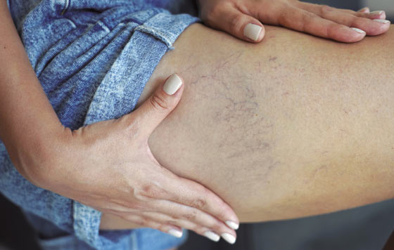 Geriatricarea, enfermedades venosas