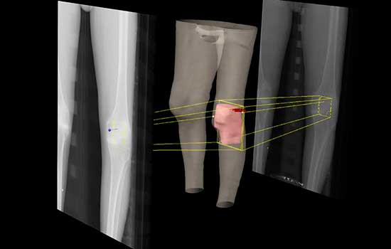 geriatricarea radioterapia patologia osteoarticular