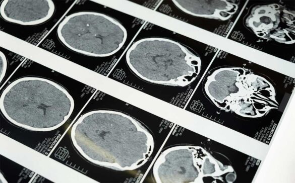 geriatricarea vitamina D Alzheimer