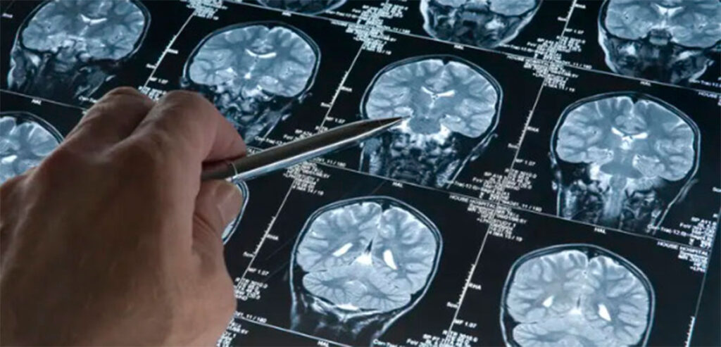 geriatricarea Diabetes alzheimer