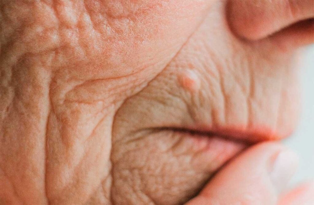 geriatricarea boca seca xerostomia