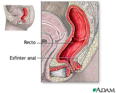 geriatricarea estrenimiento impactacion fecal
