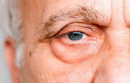 geriatricarea ojo seco